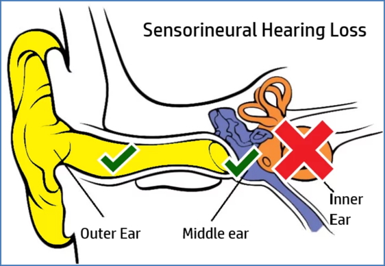 SENSORINEURAL DEAFNESS