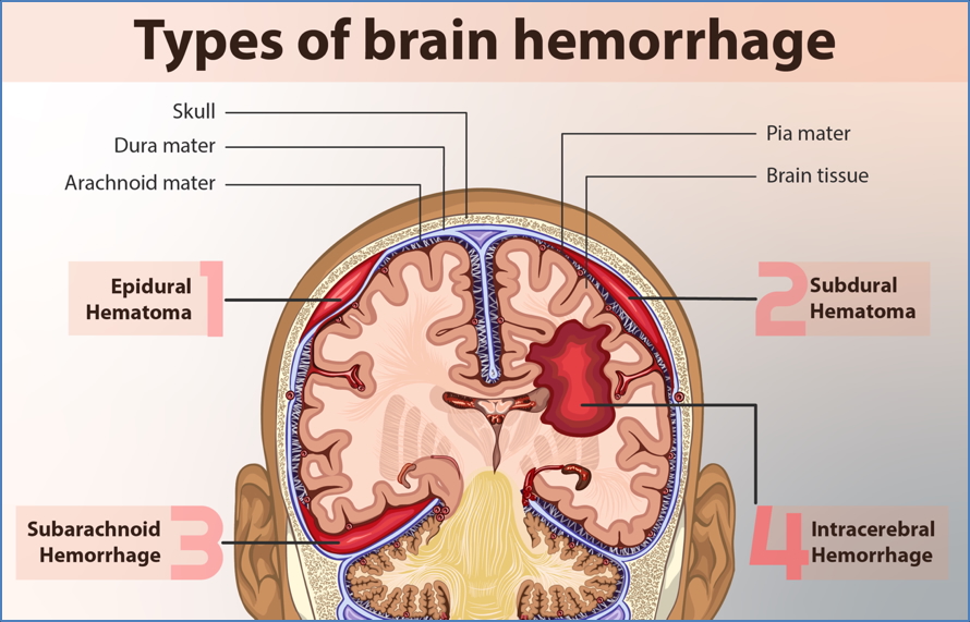 Types of intracranial hemorrhages