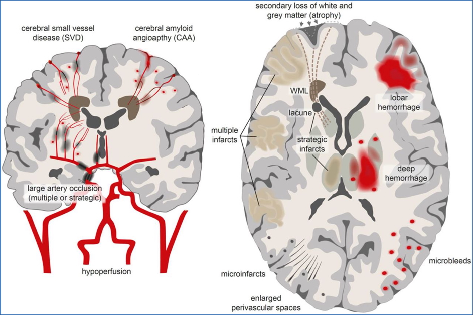 VASCULAR DEMENTIA