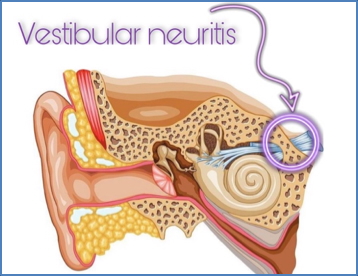 vertigo - Vestibular neuritis