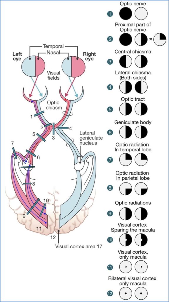 neurological patterns - Visual Field Defects