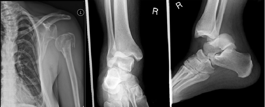 bony injuries - Dislocation