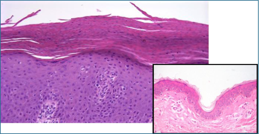 skin histology - Parakeratosis