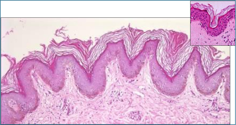 skin histology - Papillomatosis