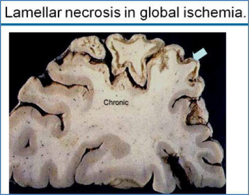 lamellar necrosis in ischaemic encephalopathy