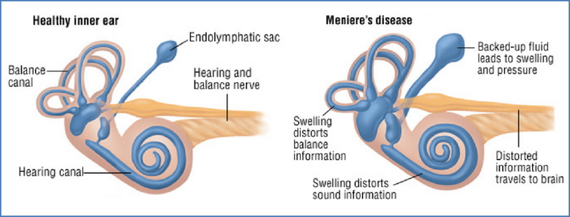 vertigo - menieres syndrome