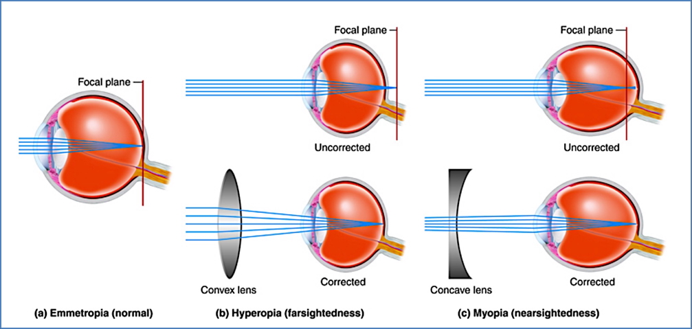 vision disorders - refractive errors