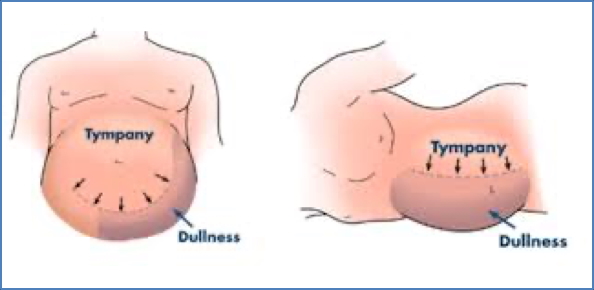 the gastrointestinal examination: Ascites & Shifting Dullness