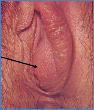 BARTHOLIN GLAND CYST