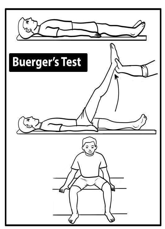 Buerger's Test