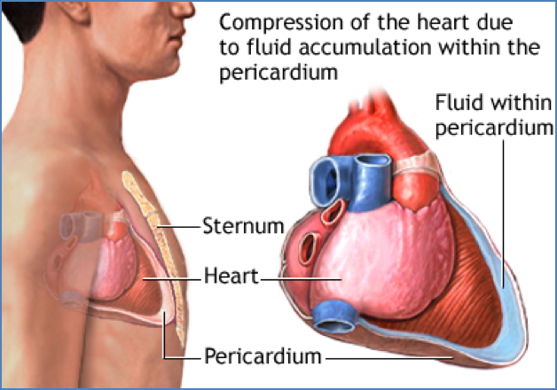 CARDIAC TAMPONADE