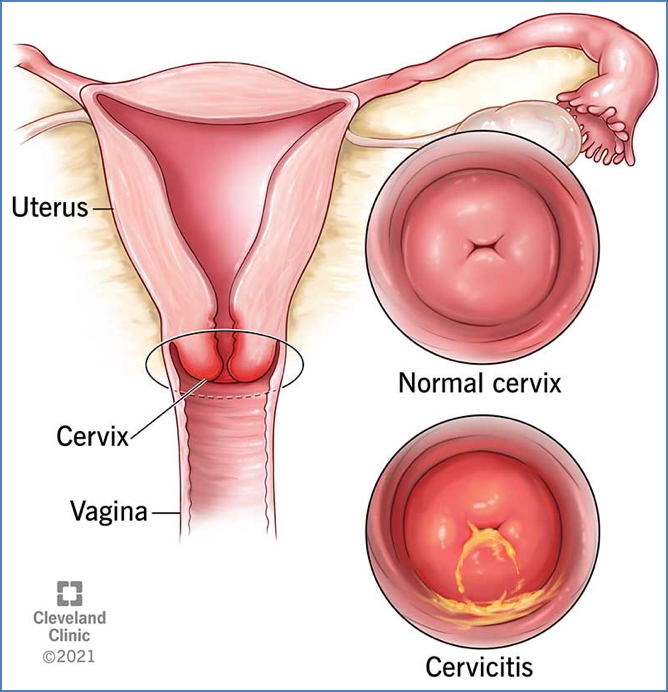 CERVICITIS
