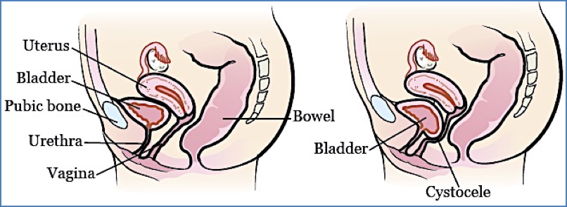 pelvic organ prolapse: CYSTOURETHROCOELE
