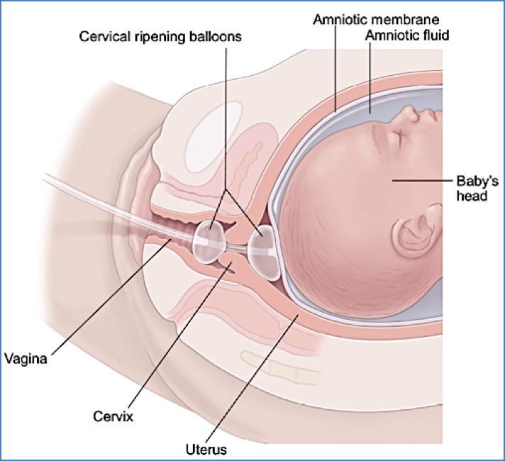 induction of labour: Cervical ‘Ripening’