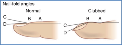 Clubbing