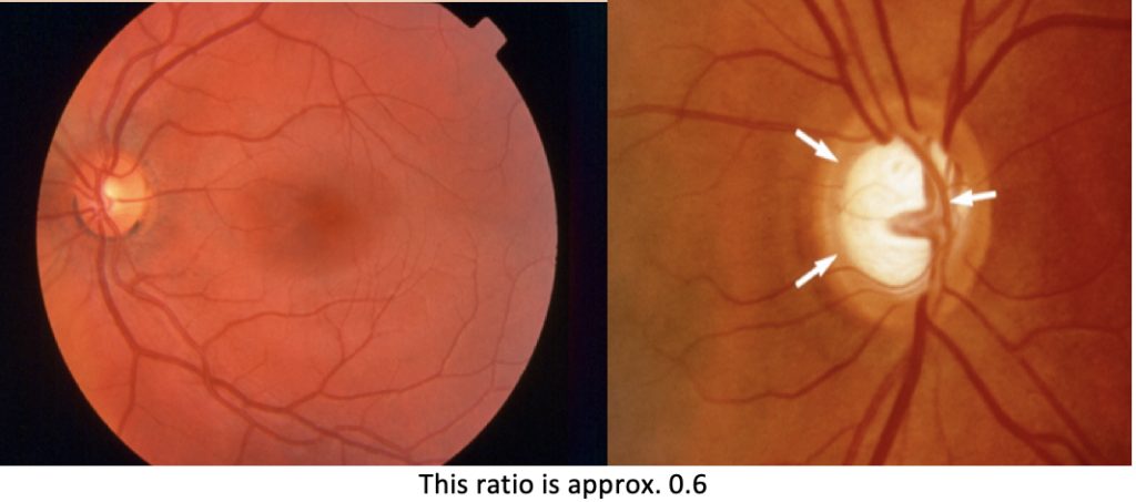 ophthalmoscopy technique: Cupping of the Disc