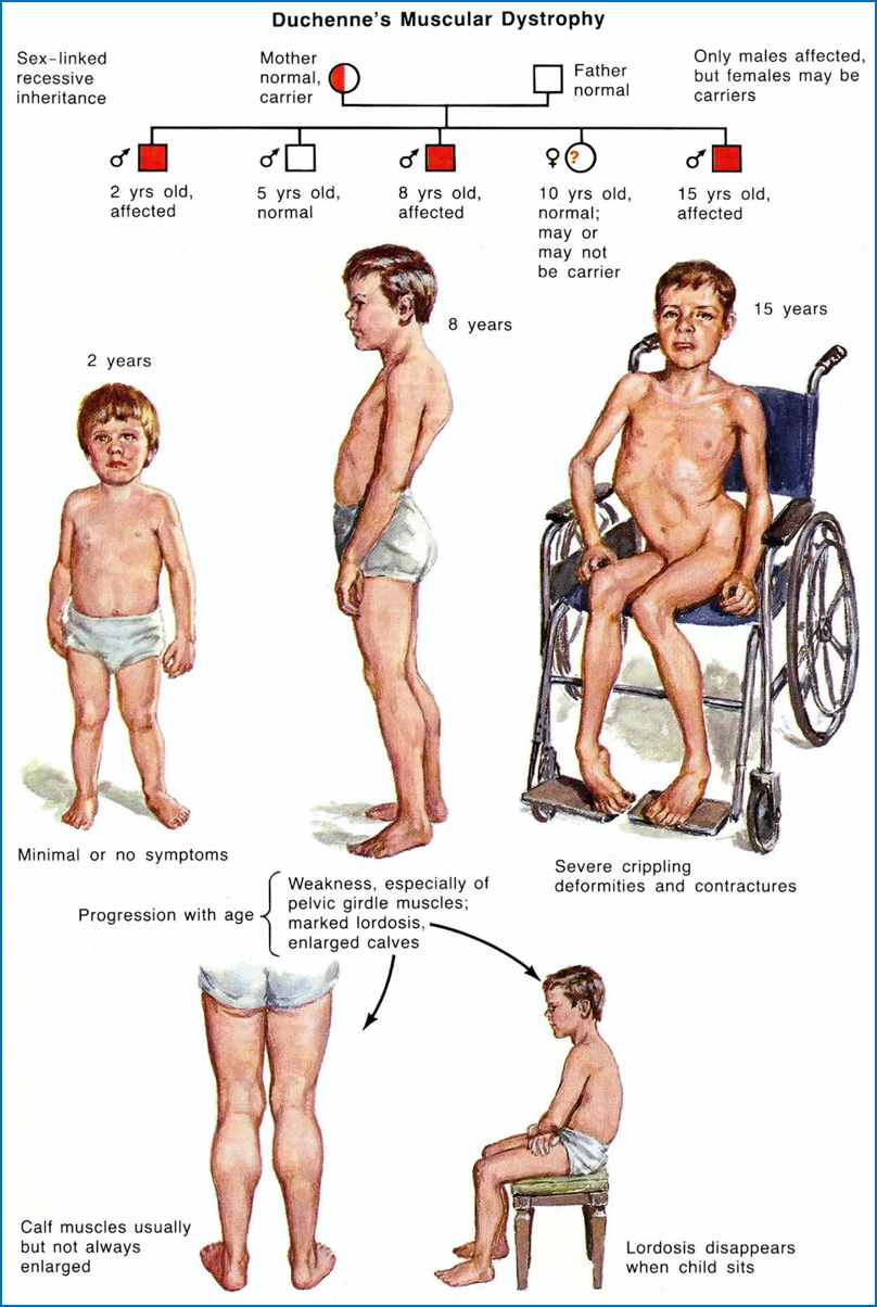DUCHENNE MUSCULAR DYSTROPHY