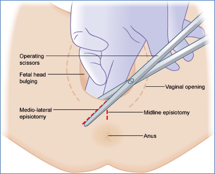 operative obstetrics: EPISIOTOMY