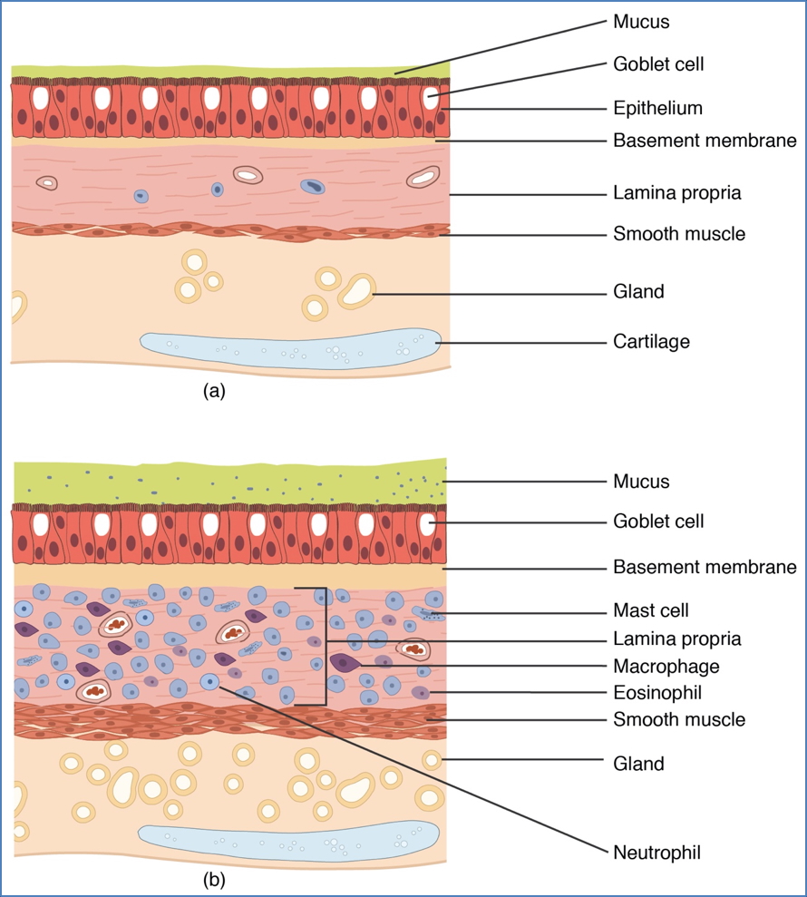 Eg- Allergic (Atopic) Asthma