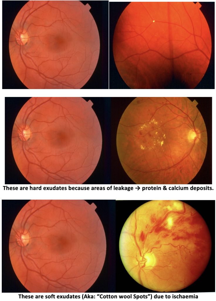 ophthalmoscopy technique: Exudates