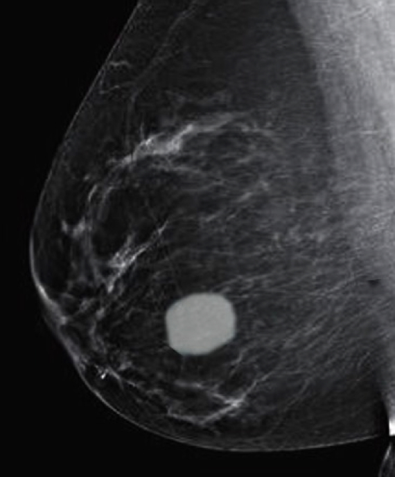 benign breast masses: FIBROADENOMA