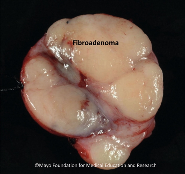 benign breast masses: FIBROADENOMA