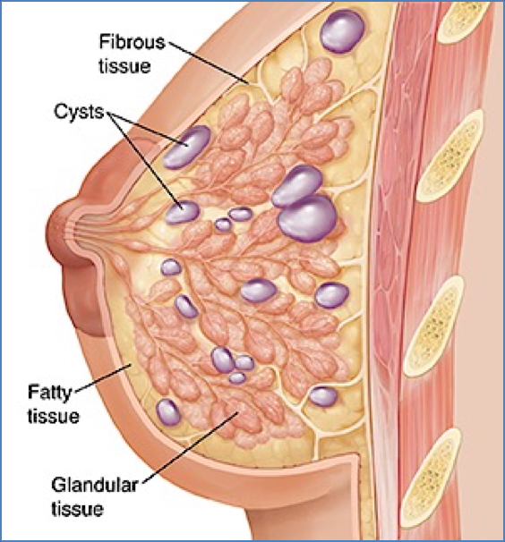 FIBROCYSTIC DISEASE