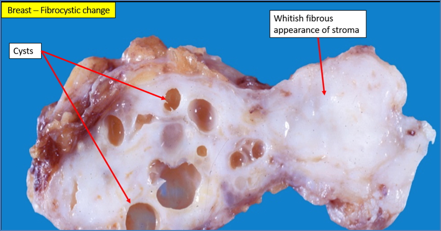 FIBROCYSTIC DISEASE