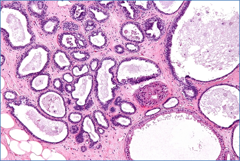 FIBROCYSTIC DISEASE