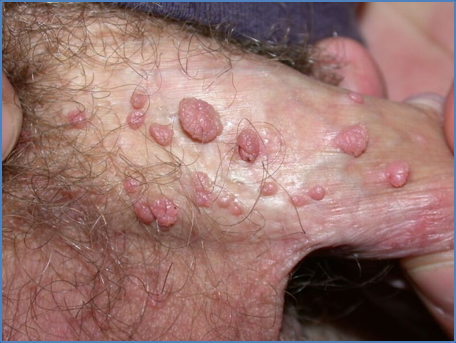 HUMAN PAPILLOMA VIRUS