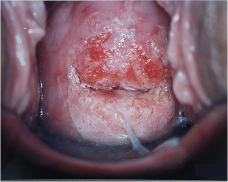 HUMAN PAPILLOMA VIRUS