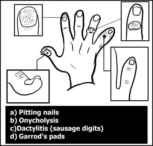 Hand exam - nail abnormalities