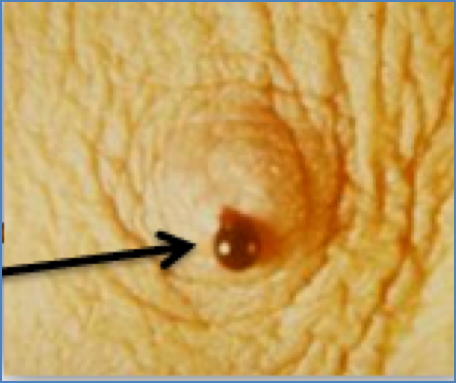 INTRADUCTAL PAPILLOMA