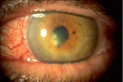 eye examination: Iris Opacities