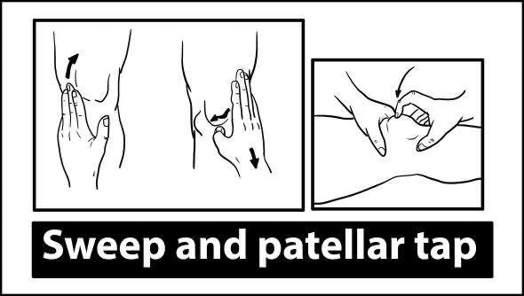 Knee Exam - Patellar tests