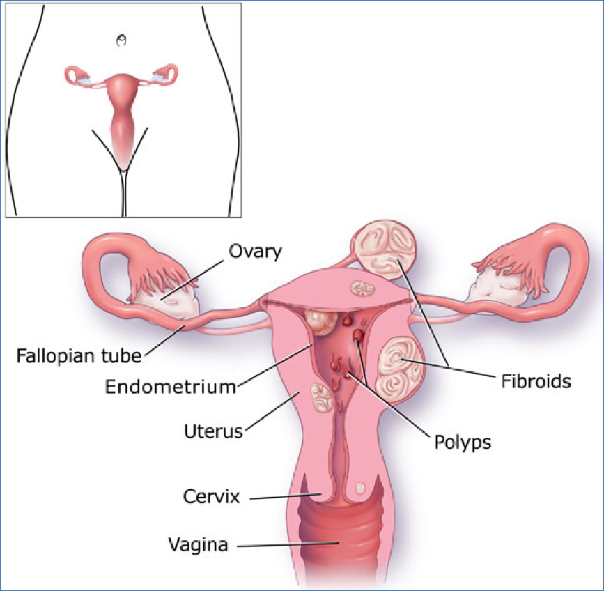 MENORRHAGIA causes