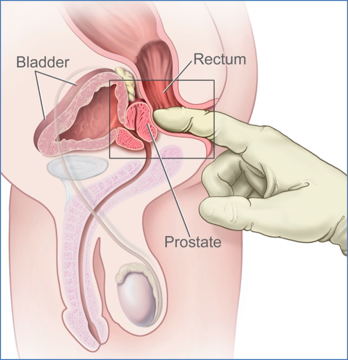 Male Digital Rectal Examination & Prostate Examination