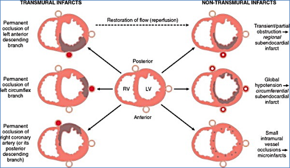 Most Common Coronary Obstruction & Locations of Ischaemia in Acute Coronary Syndromes