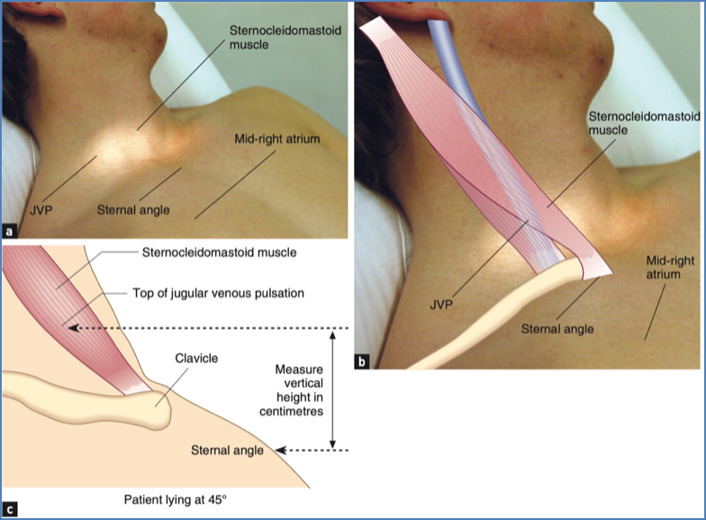 the cardiovascular examination: Neck / JVP