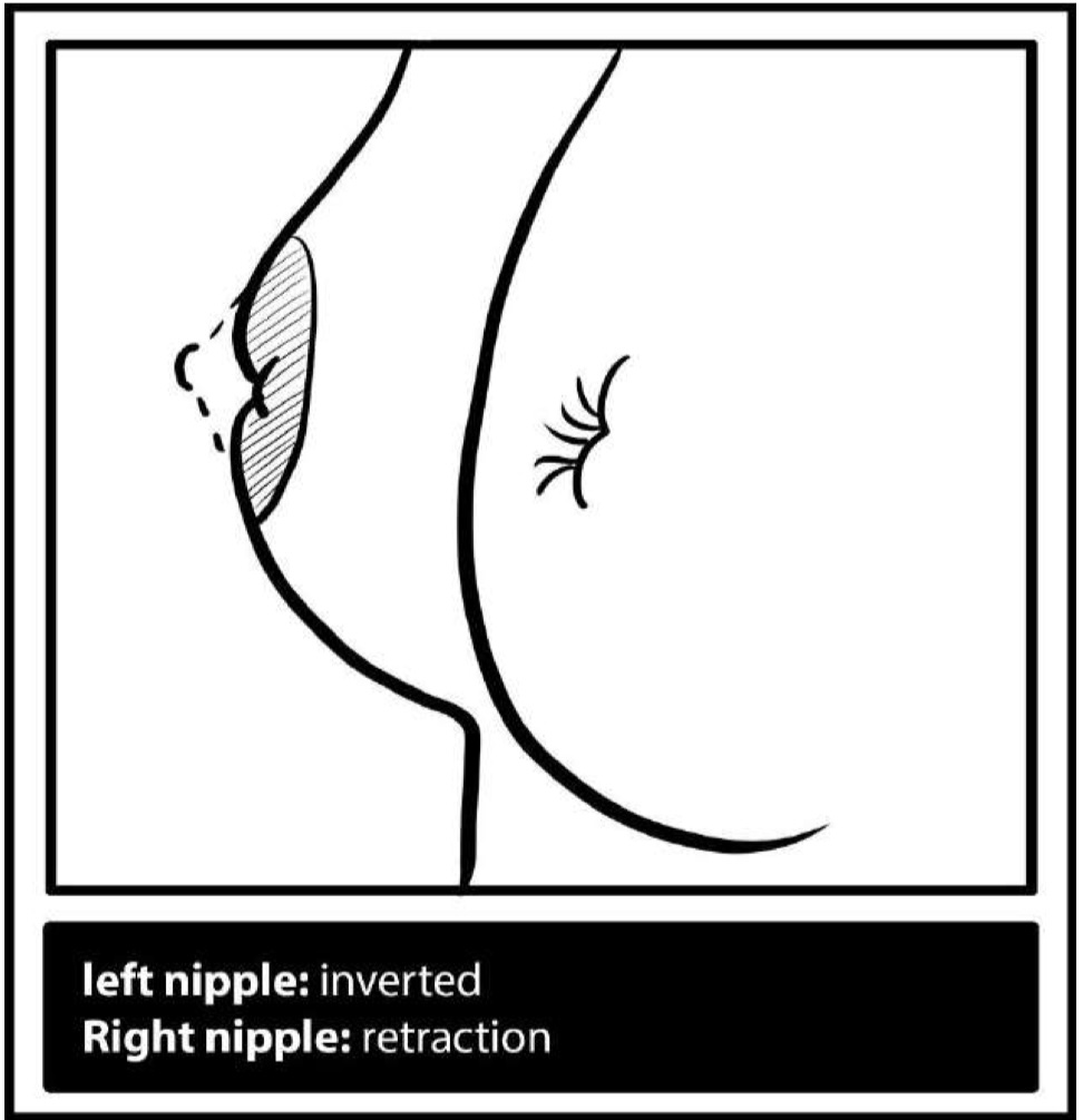 Nipple-inversion-retraction