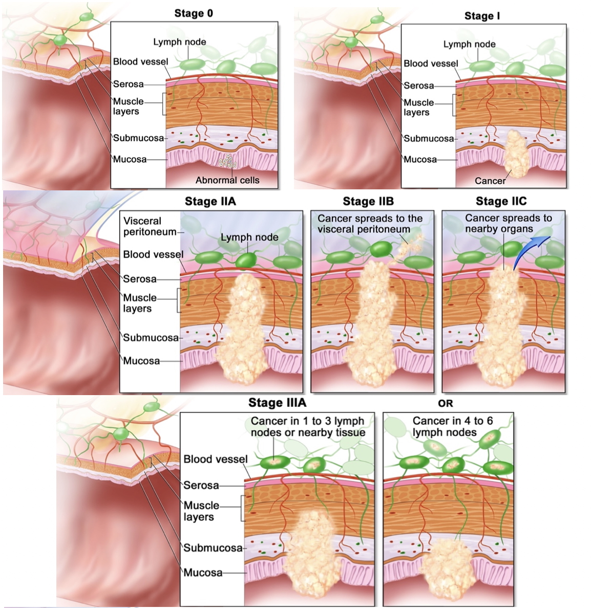 Colorectal cancer staging