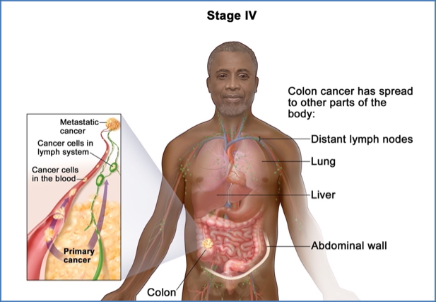 Colorectal cancer staging