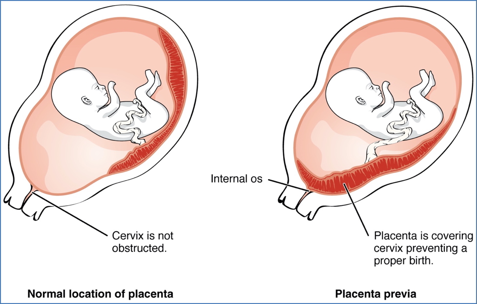 obstetrical haemorrhage: PLACENTA PREVIA