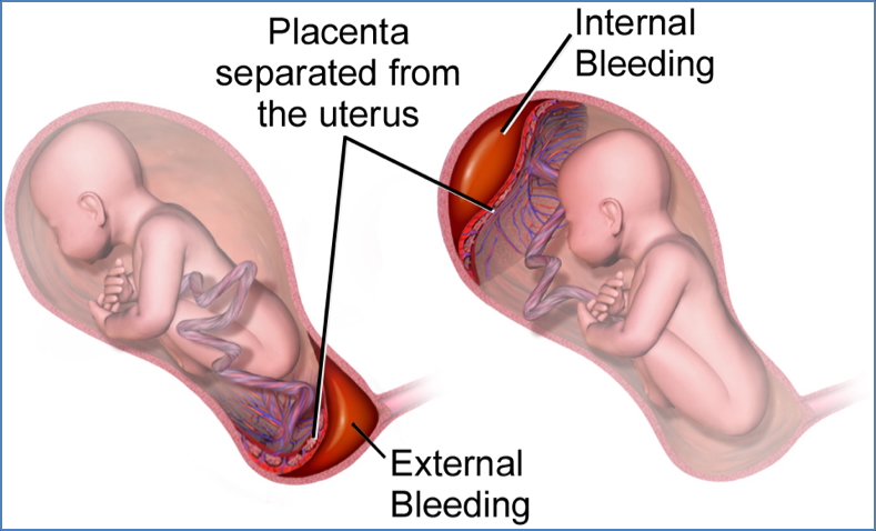 obstetrical haemorrhage: PLACENTAL ABRUPTION
