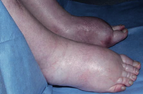 Peripheral Oedema