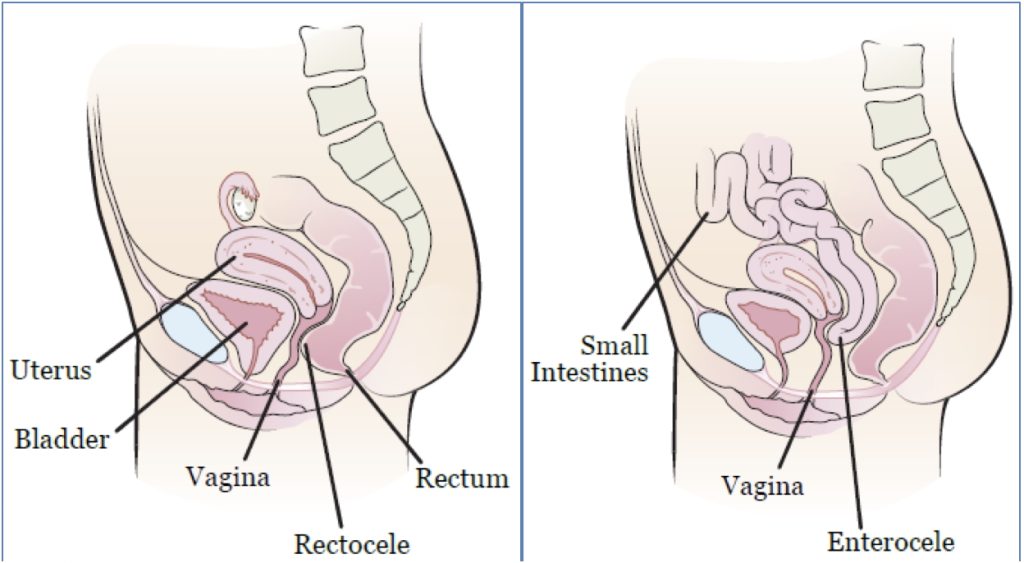 pelvic organ prolapse: Posterior Prolapses