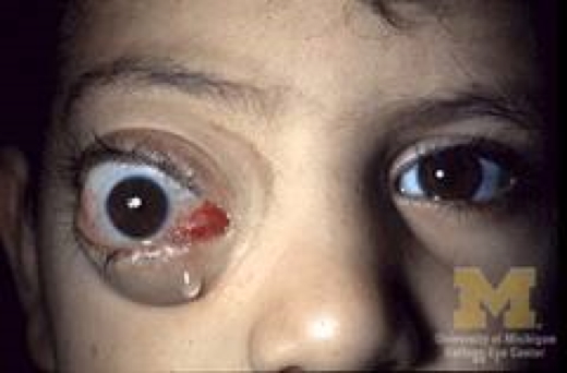 eye examination: Proptosis