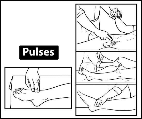Arterial Vascular Examination: Pulses