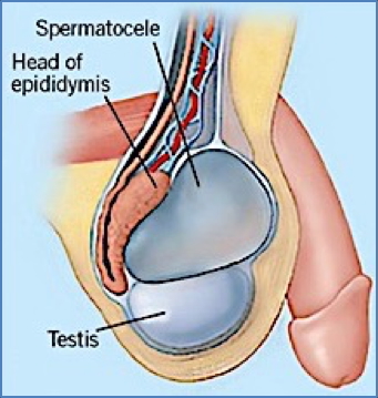 scrotal accumulations: SPERMATOCOELE
