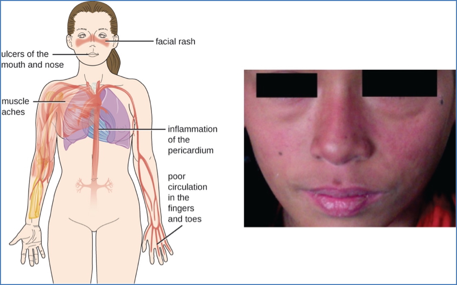 Systemic Lupus Erythematosus